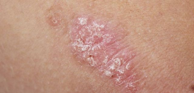 Comment traiter le psoriasis ?