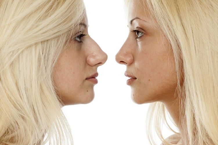 Comment ça se passe après une Rhinoplastie ?